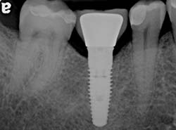 X-ray of an implant in position
